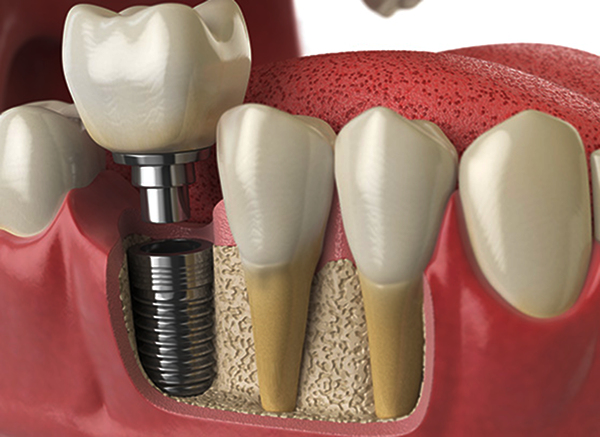 IIT-D & MAIDS scientists develop indigenous tech for user-friendly, affordable tooth implants