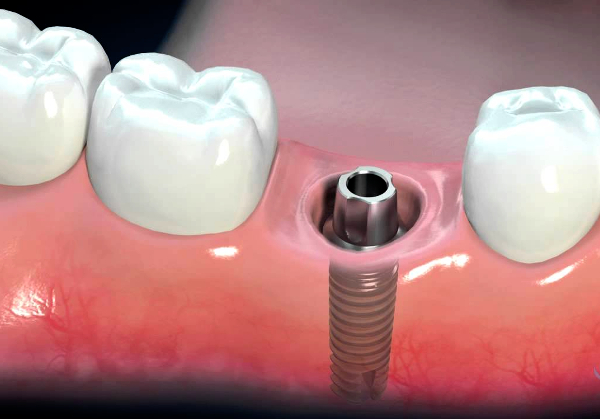 Agharkar Instt, Pune develops materials that can reduce dental implant failure